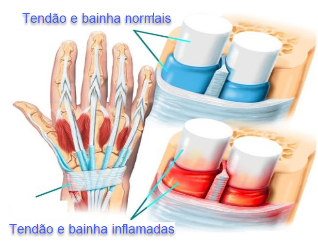 Tendões afetados na tendinopatia de De Quervain