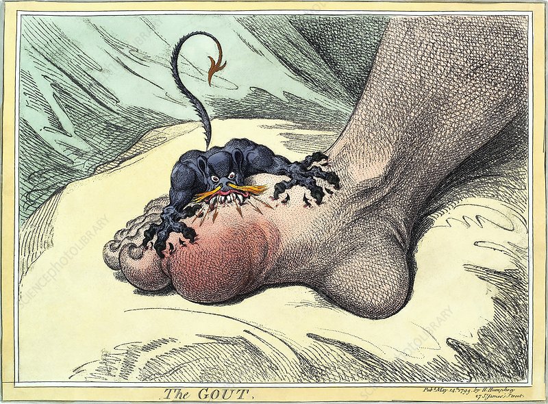 gota, gout