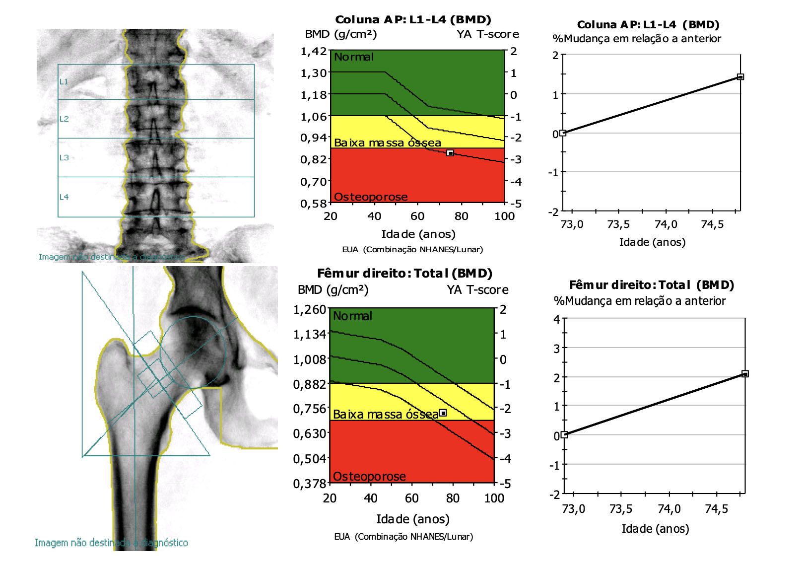 densitometria óssea mostrando  osteoporose pós menopausa
