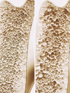 osteoporose