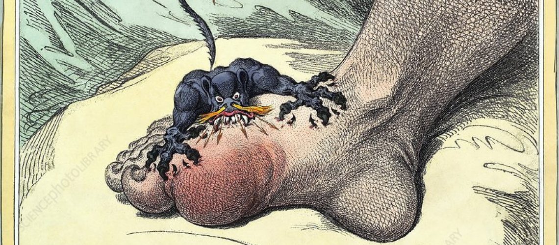 gota, gout